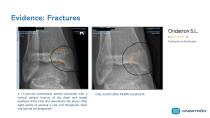 Sales brochure Ondatron_PEMF's Therapy for bone recovery-11
