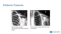 Sales brochure Ondatron_PEMF's Therapy for bone recovery-12