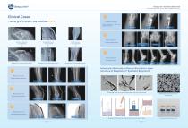 Synthetic Bone Graft Brochure  DeepActive™-5