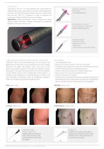 LASEmaR® 1500 - 4