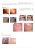 LASEmaR® 800-3