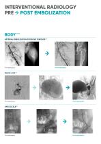 Glubran 2 ENDOVASCULAR-4