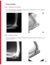 OL - Olecranon Locking Plate - 15