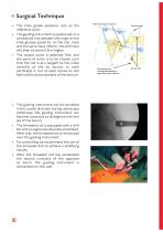 SR Sacral Rods - 10