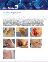 DIABETIC SKIN ULCER-4