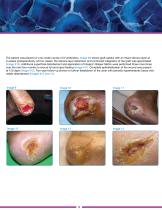 DIABETIC SKIN ULCER-9