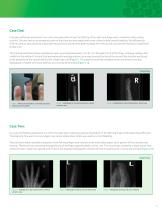 Integra® Bilayer Wound Matrix for the Management of Transverse Fingertip Injuries-3