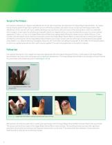 Integra® Bilayer Wound Matrix for the Management of Transverse Fingertip Injuries-4