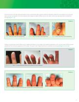 Integra® Bilayer Wound Matrix for the Management of Transverse Fingertip Injuries-5