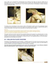 M.T.P. arthrodesis Hallu®-Fix system-5