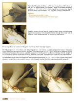 M.T.P. arthrodesis Hallu®-Fix system-6
