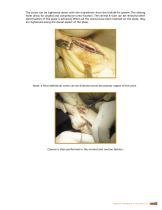 M.T.P. arthrodesis Hallu®-Fix system-7