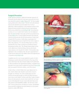 SurgiMend® Case Study: Hernia Repair by Minimally Invasive Component Separation Reinforced with SurgiMend®-3