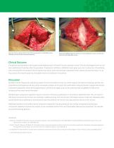 SurgiMend® Case Study: Hernia Repair by Minimally Invasive Component Separation Reinforced with SurgiMend®-4