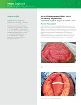 SurgiMend® Case Study: Successful Management of Giant Ventral Hernia Using SurgiMend® 3.0-2