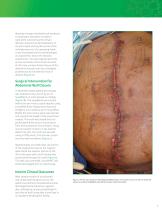 SurgiMend® Case Study: Successful Management of Giant Ventral Hernia Using SurgiMend® 3.0-3