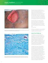 SurgiMend® Case Study: Successful Management of Giant Ventral Hernia Using SurgiMend® 3.0-4