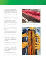 SurgiMend® Case Study: Successful Management of Giant Ventral Hernia Using SurgiMend® 3.0-5