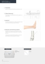 Orthopedic - ARIX Ankle System - 3.5 Distal Tibia - 12