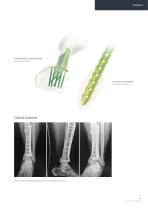 Orthopedic - ARIX Ankle System - 3.5 Distal Tibia - 9