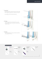 Orthopedic - ARIX Ankle System - Distal Tibia SMO and Fusion - 17