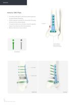 Orthopedic - ARIX Ankle System - Distal Tibia SMO and Fusion - 8