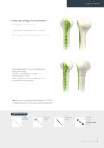 Orthopedic - ARIX Humerus System - 9
