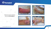 EXPERIENCE OF USING SILVER &IODINE CONTAINING WOUND - 10