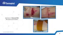 EXPERIENCE OF USING SILVER &IODINE CONTAINING WOUND - 12