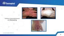 EXPERIENCE OF USING SILVER &IODINE CONTAINING WOUND - 13