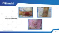 EXPERIENCE OF USING SILVER &IODINE CONTAINING WOUND - 14