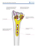 Valley Volar Distal Radius Locking Plate-2
