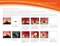 Ridge Augmentation with MinerOss, MinerOss X and Mem-Lok RCM - 1