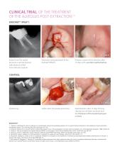 Kit PRGF – ENDORET® - Alveolus Post-Extraction - 3