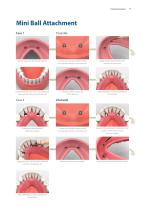 Overdenture System - 17