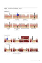 Surgical Guide SGCM-1312 [Rev.1] - 13