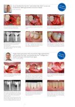 Peri-Implant Augmentation-2