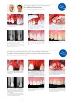 Peri-Implant Augmentation-3