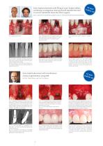 Peri-Implant Augmentation-4