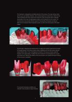 Gold-Standard for Implant Superstructures-6