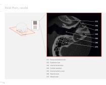 3D Accuitomo Clinical Case Evidence - 14