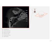 3D Accuitomo Clinical Case Evidence - 15