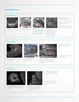 ExAblate OR Brochure for outside USA-6