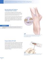 DeNovo® NT Natural Tissue Graft Arthroscopically-Assisted Surgical Technique for Ankle Cartilage Repair - 4