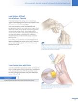 DeNovo® NT Natural Tissue Graft Arthroscopically-Assisted Surgical Technique for Ankle Cartilage Repair - 5