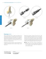 Distal Femoral Replacement-12
