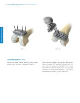 Distal Femoral Replacement-14