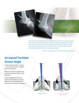 NexGen High-Flex Implant-5