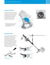 Trabecular Metal Modular Acetabular System Surgical Technique - 7