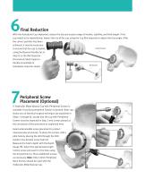 Trabecular Metal Natural Cup System Surgical Technique - 4